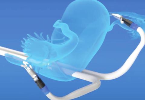Memic Innovative Surgery’s Hominis Surgical System is the first and only surgical robot with humanoid shaped arms including shoulder, elbow and wrist joints, and it's designed to replicate the motions and capabilities of a surgeon’s arms. SUBMITTED PHOTO